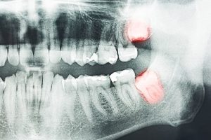 רשלנות רפואית צילום שיניים